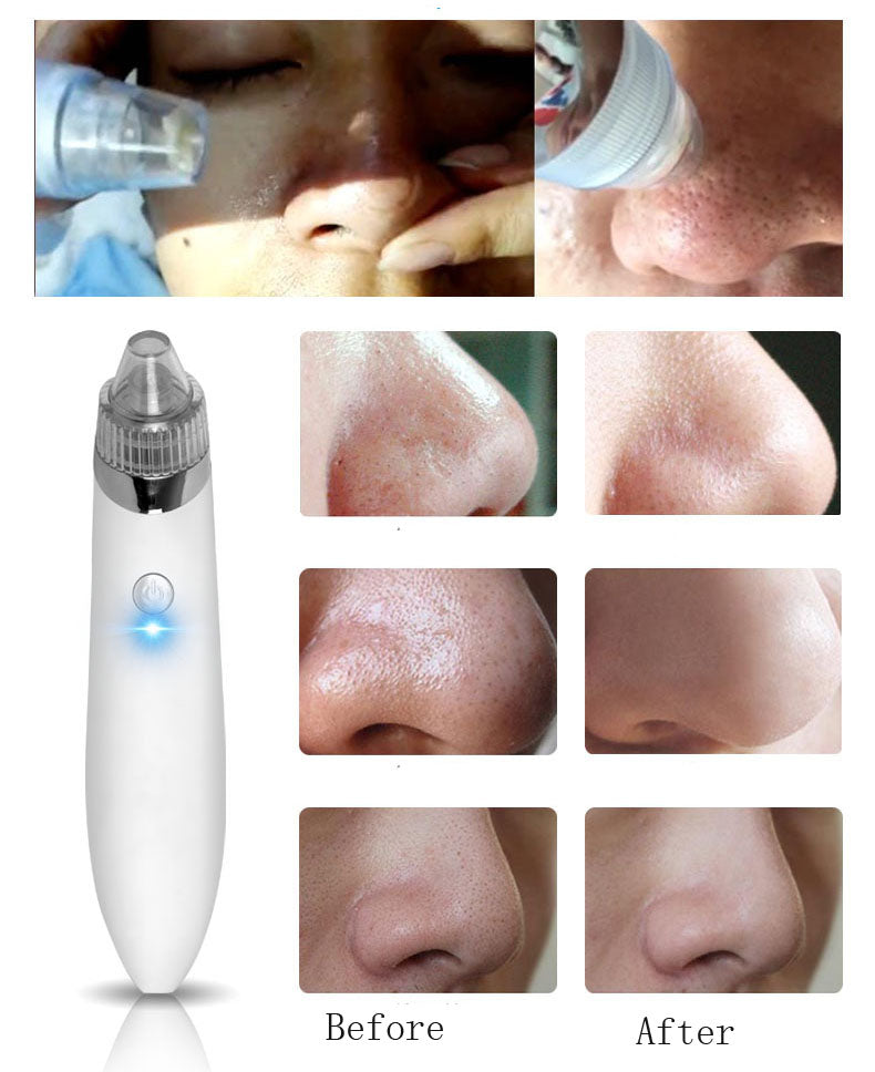 Acne Vacuum Suction Beauty Machine
